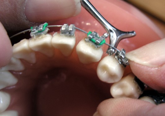 Aparato dental para niños: brackets